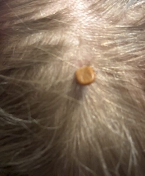 Engorged tick attached to a child’s scalp and partly hidden beneath the hair