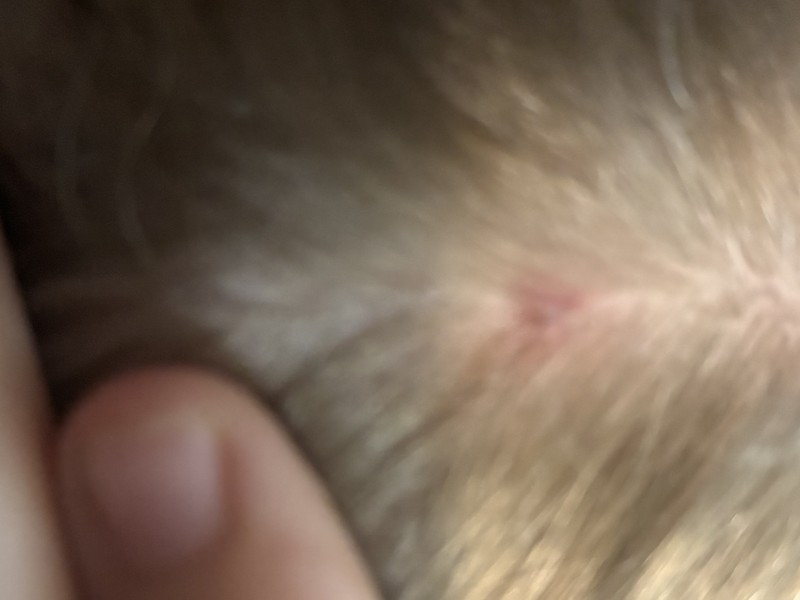 Small pink tick bite site on a child’s scalp immediately after the tick was removed